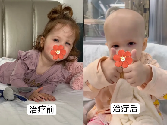 “You have given our daughter a future we never thought possible”. — A Swedish child with a rare genetic disease travels thousands of miles to Guangdong for gene therapy and is reborn
